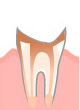 C4【歯根まで達した虫歯】