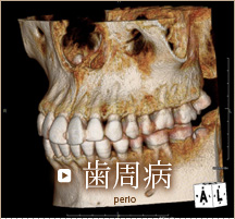 歯周病